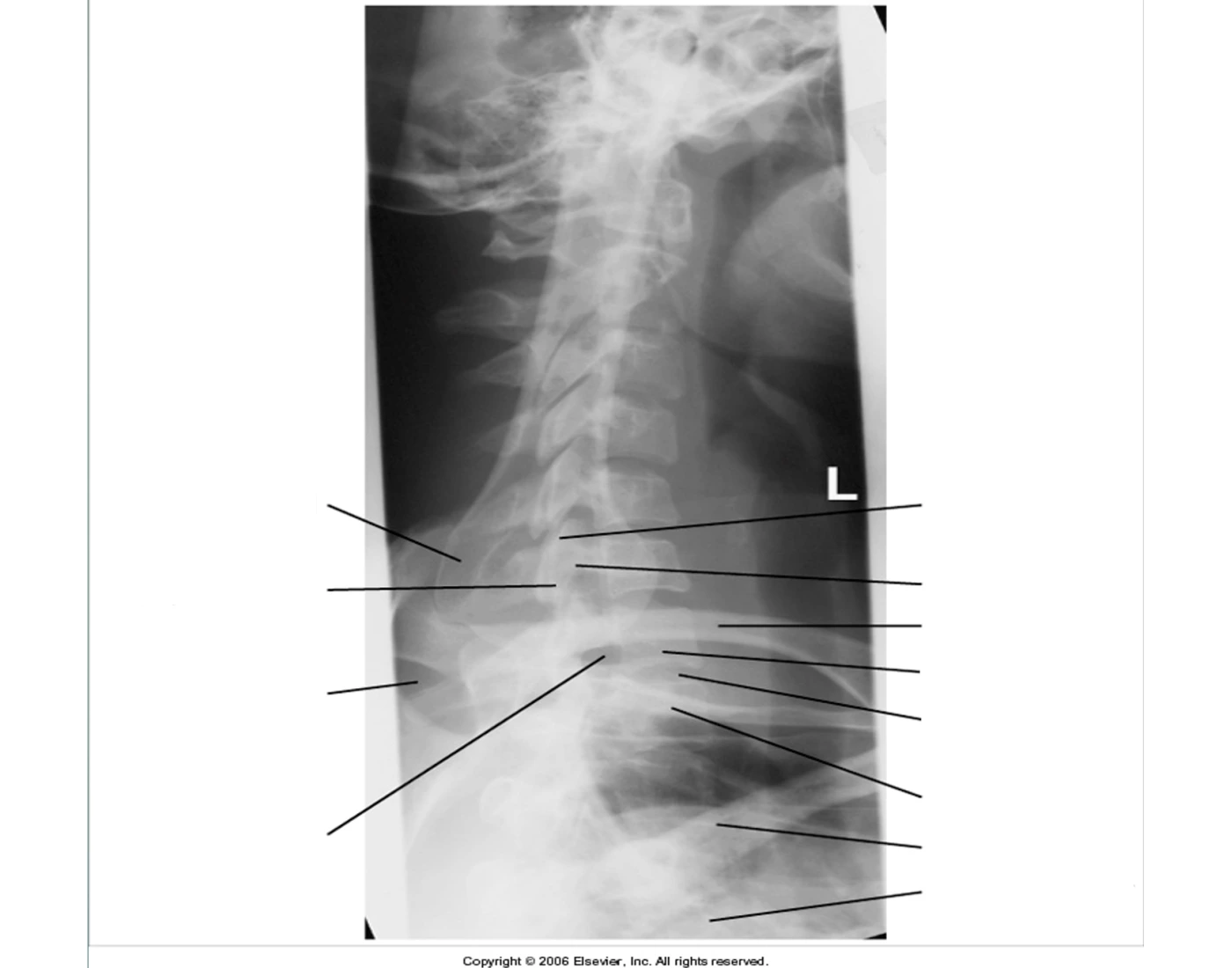 Twining Method Radiography Lateral Twining