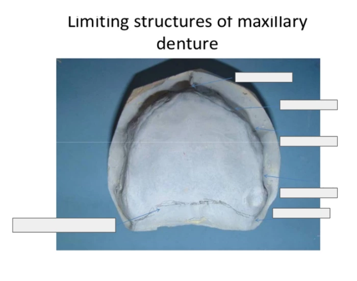 Limiting structures of maxillary denture Quiz