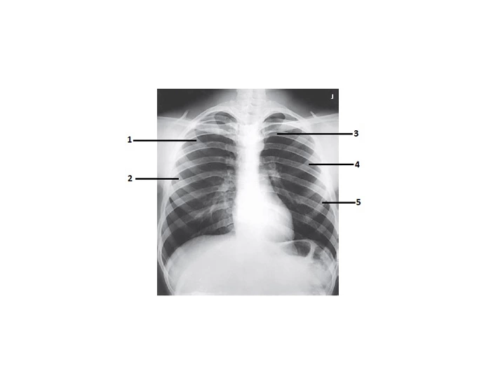 PA Rib X-ray Anatomy Quiz