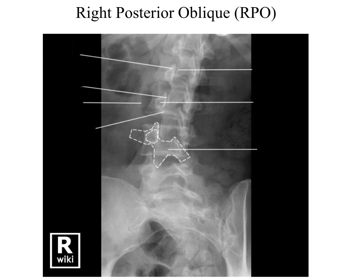 Right Posterior Oblique L spine (RPO) Quiz