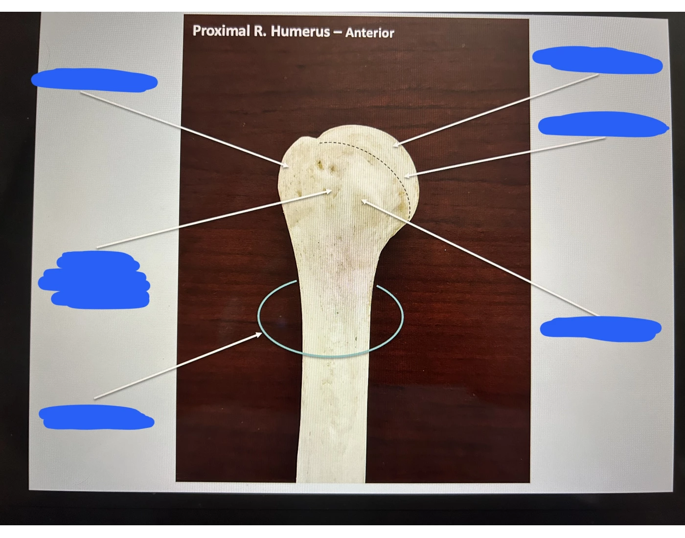 Promixol R Proximal R. Humerus Quiz