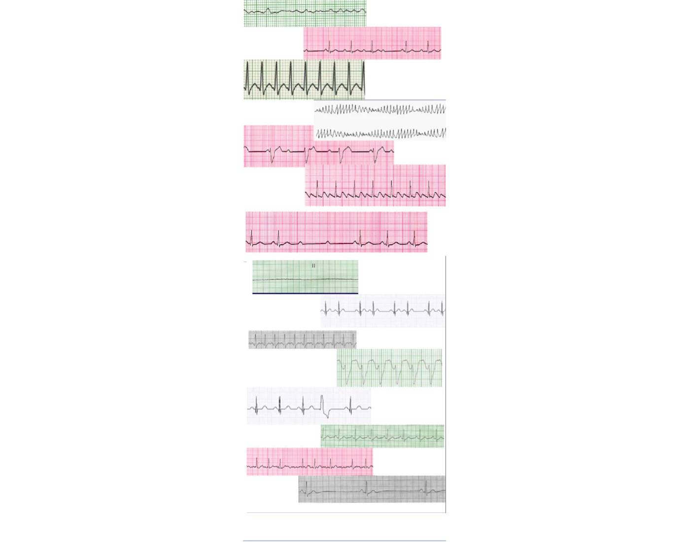 Cardiac Rethym Example Cardiac Rhythms Quiz