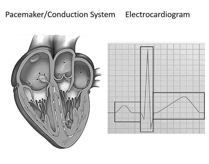 Pacemaker Labelling Pacemaker/Electrocardiogram Labeling Quiz