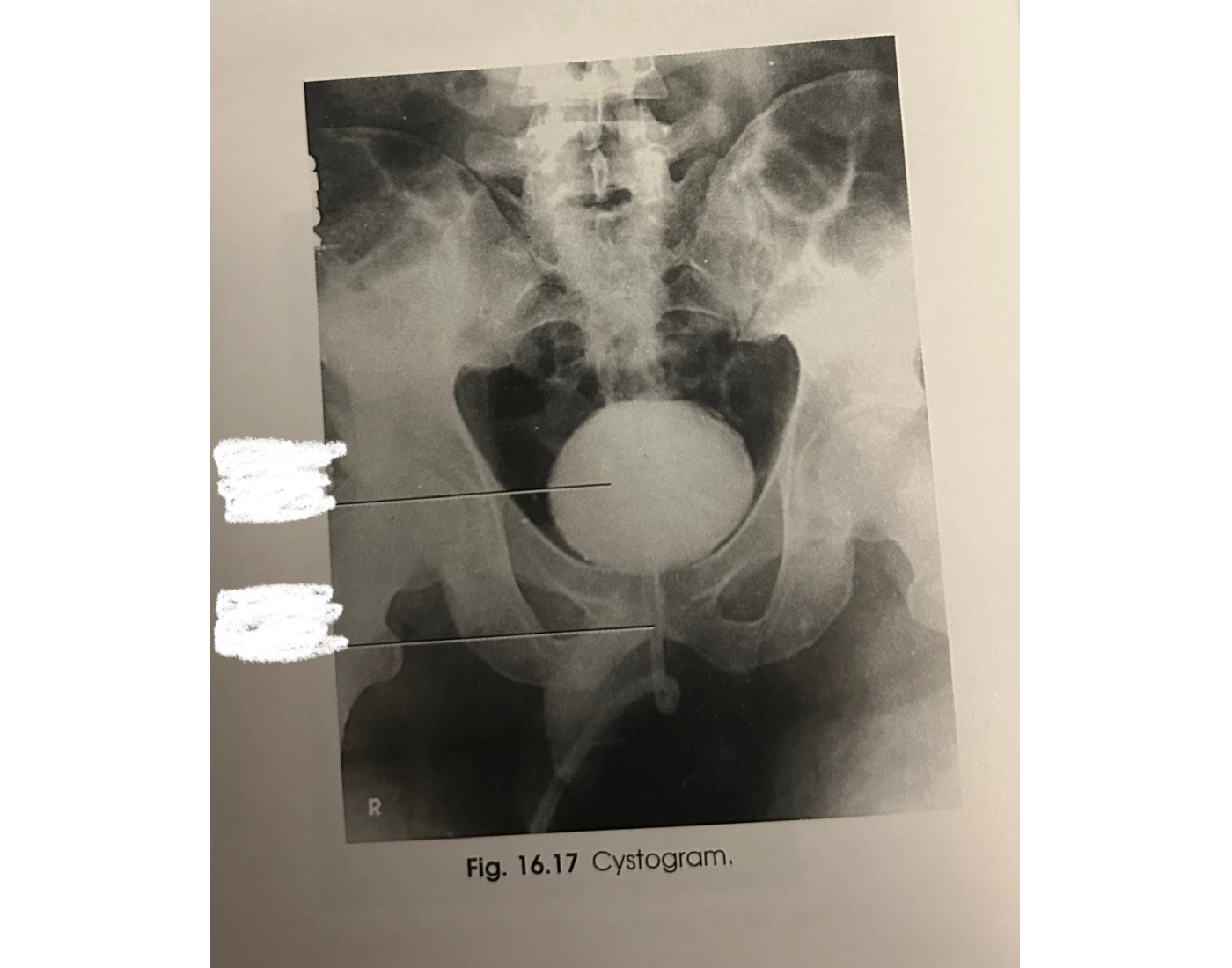 Traditional Cystogram Cystogram — Printable Worksheet