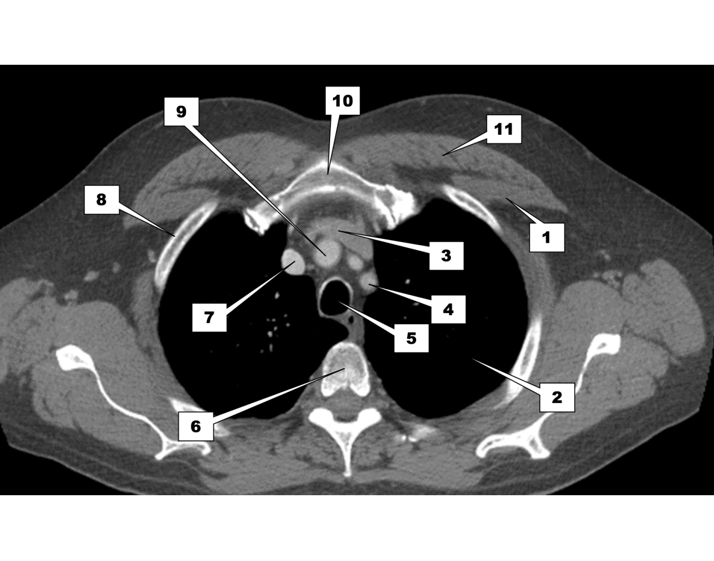 Axial CT Chest Anatomy Quiz