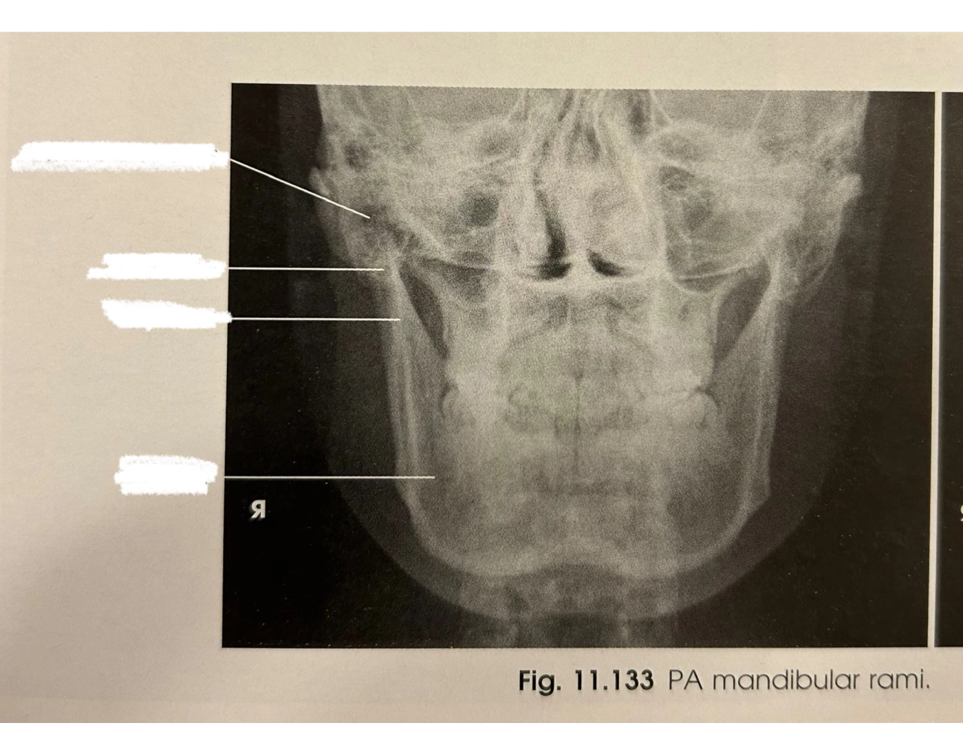 PA Mandibular Rami — Printable Worksheet