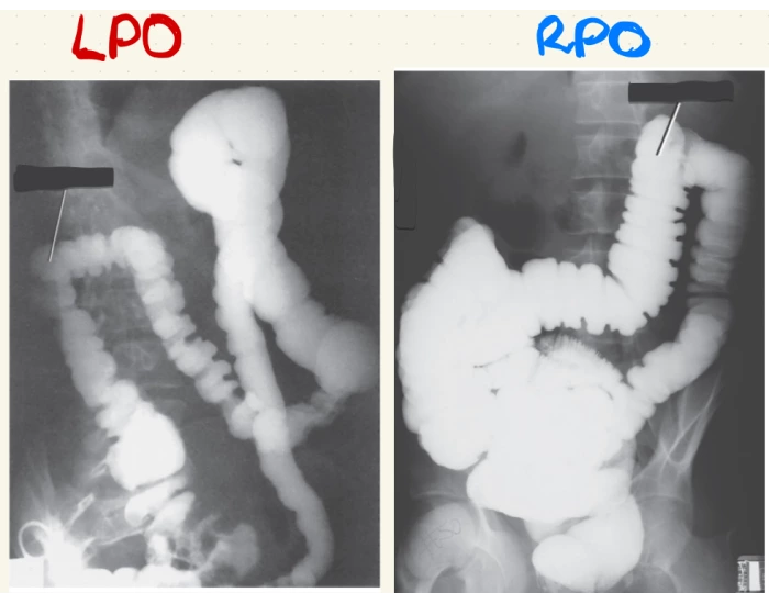 Lpo And Rpo Examples LPO and RPO Barium Enema Quiz