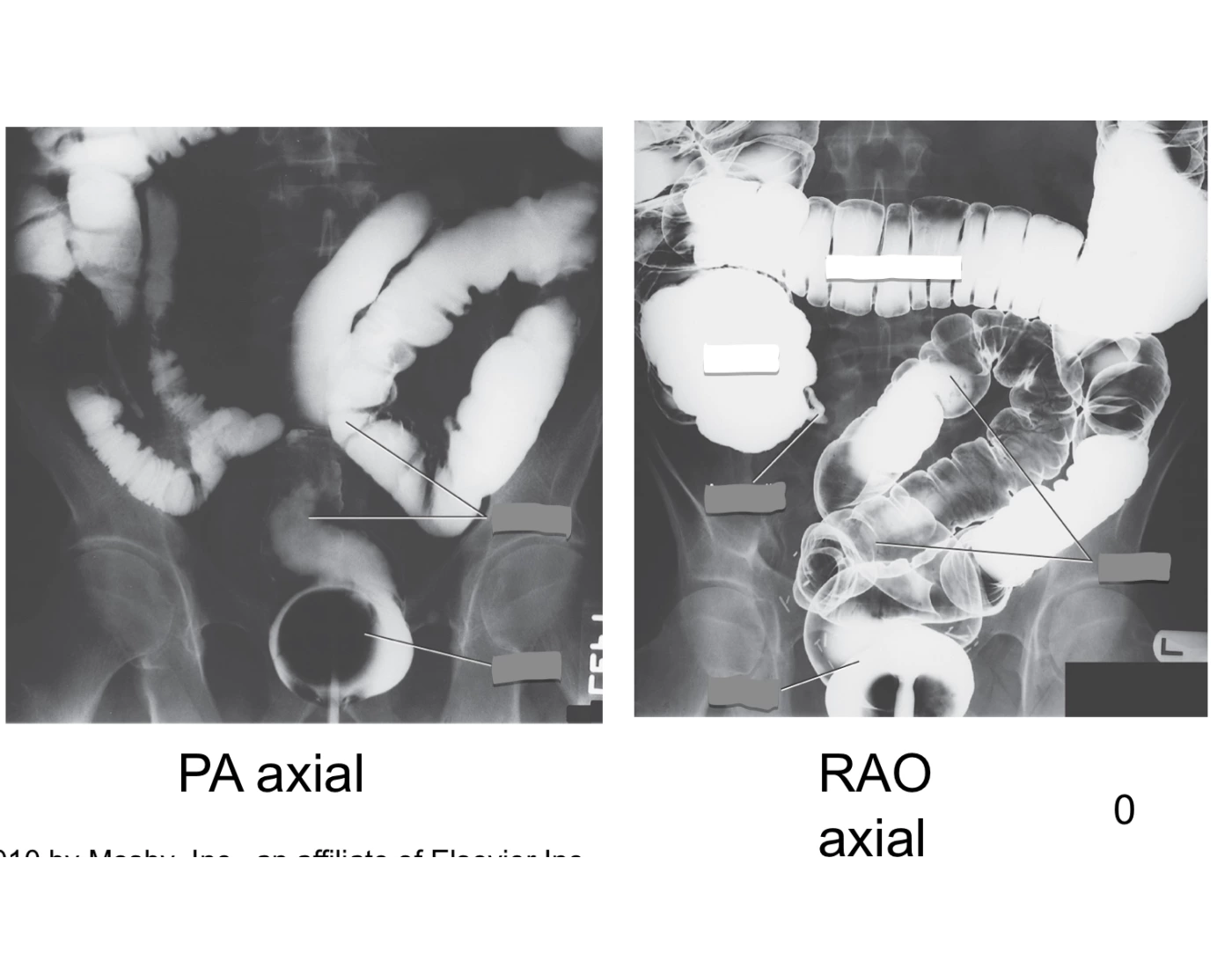 AP or PA axial & AP or PA axial oblique Quiz