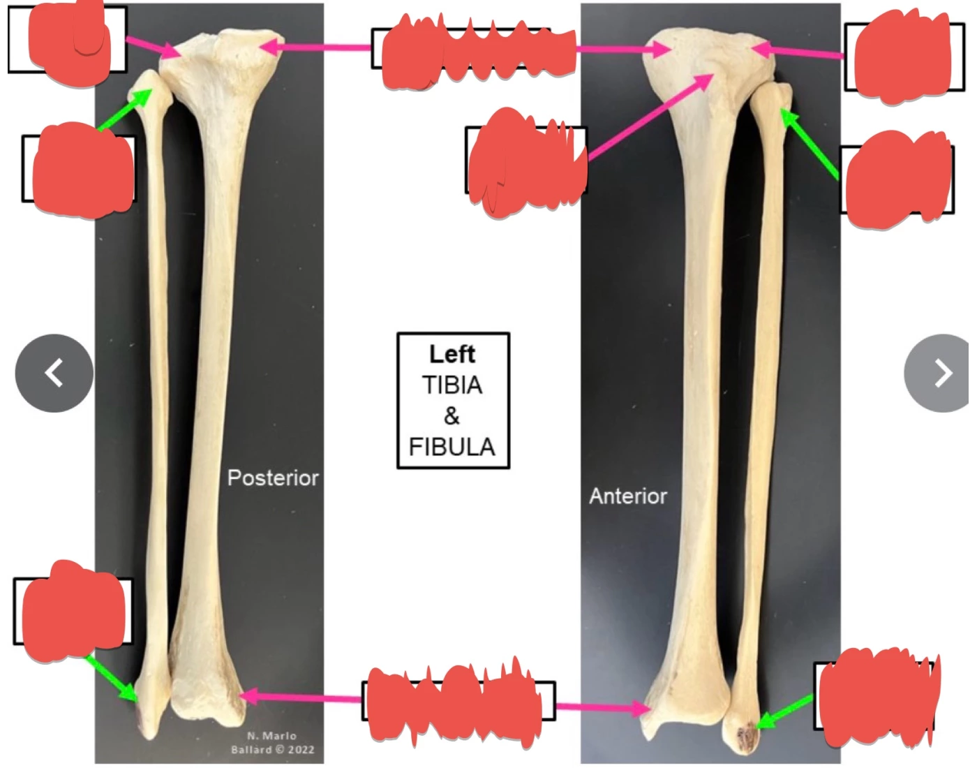 Trivia Tibia Bones of the Tibia and Fibula Quiz