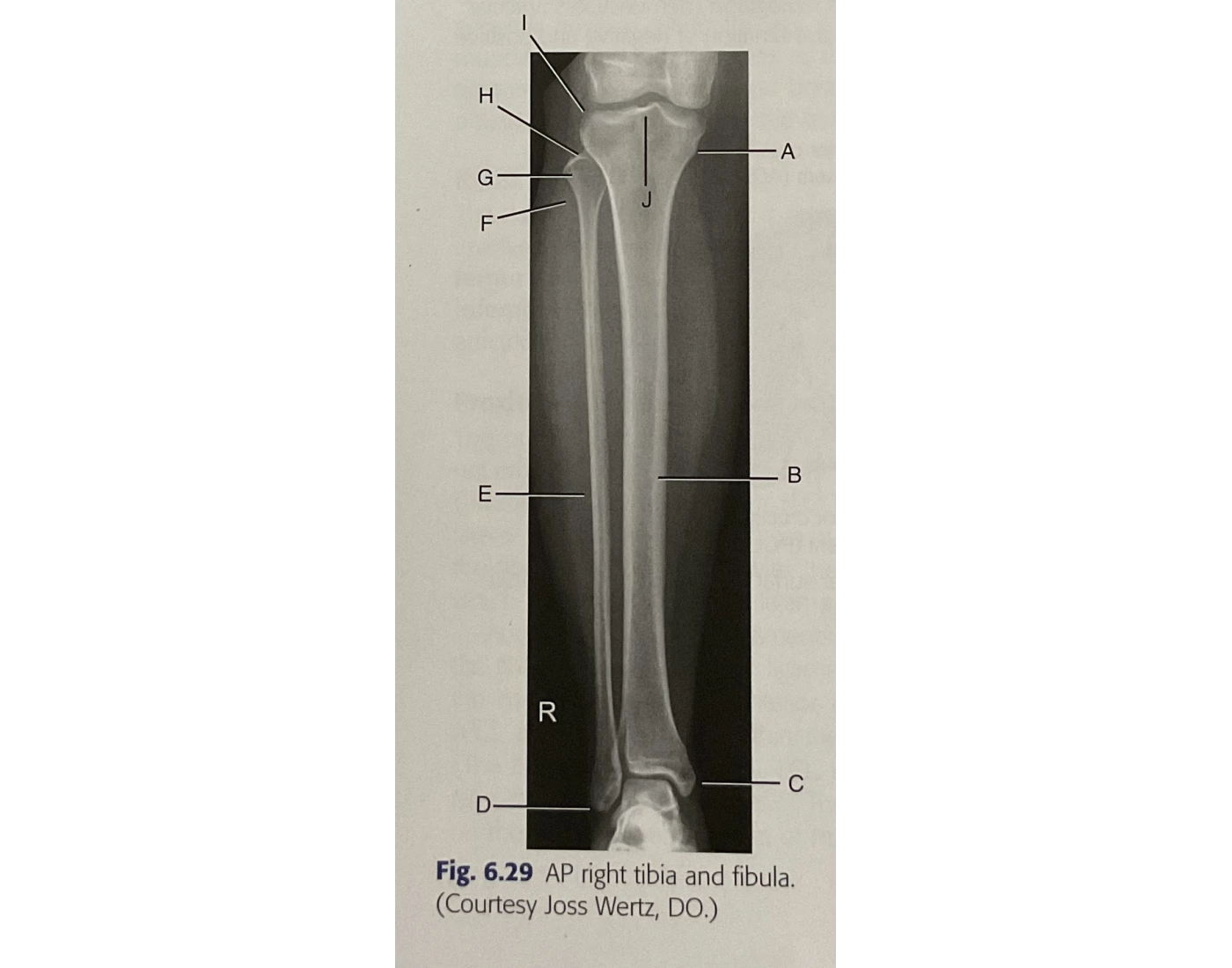 Fig 6.29 AP right tibia and fibula Quiz