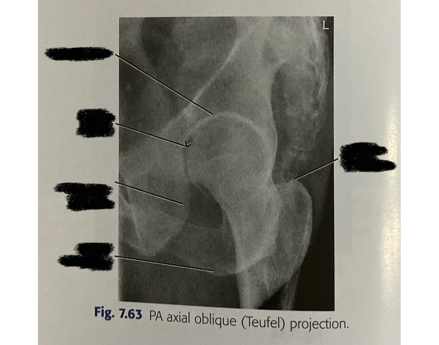 Tuefel Method Fig 7.63 PA axial oblique (Teufel) projection Quiz
