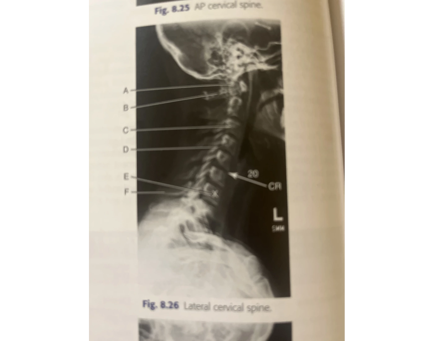 Left lateral cervical spine Quiz