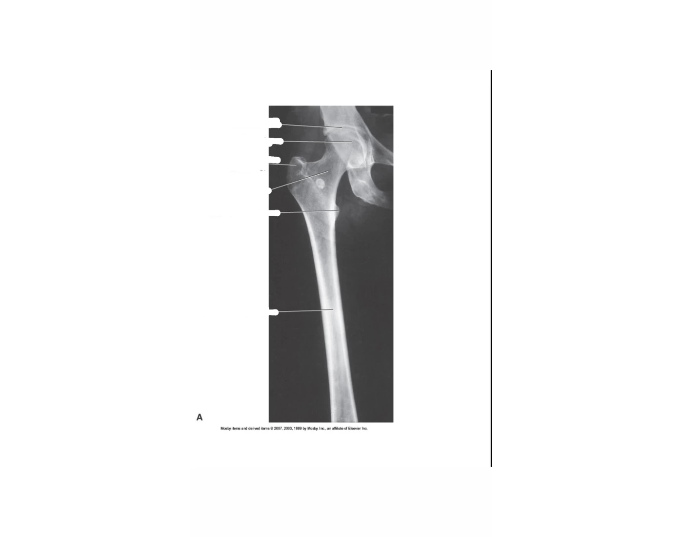 AP PROXIMAL AND MID FEMUR — Printable Worksheet