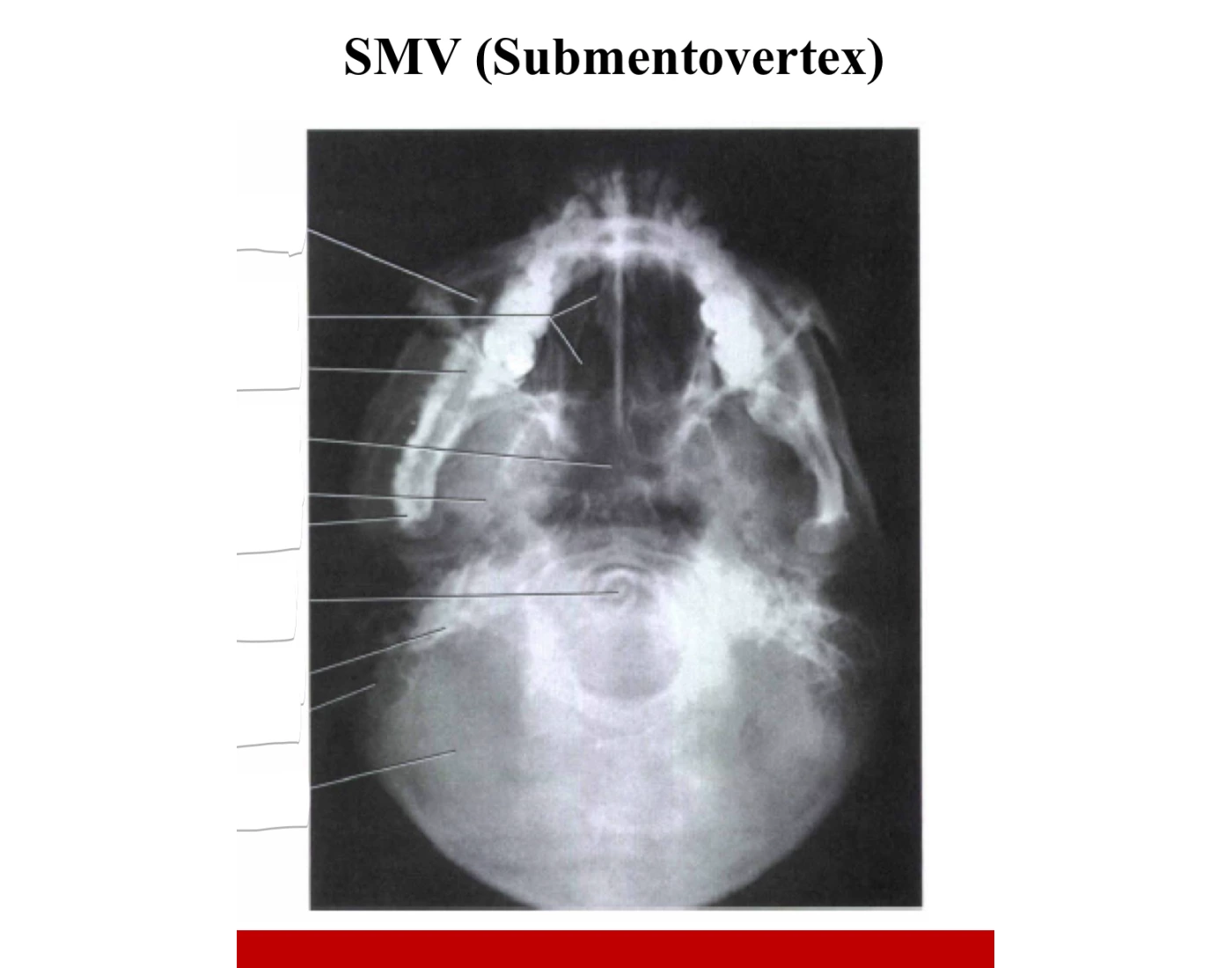 Smvec Front Submentovertex (SMV) view Quiz
