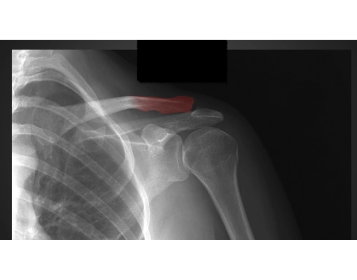 Shoulder Girdle X-Ray Quiz