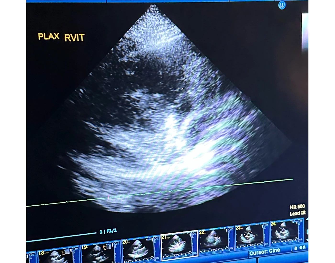 Plax Rvit With Color PLAX RVIT Quiz