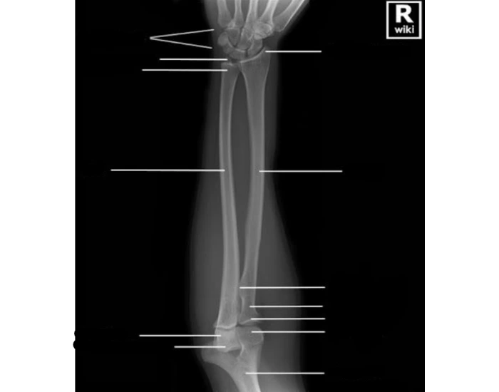 Radius and Ulna Xray Anatomical Parts — Printable Worksheet