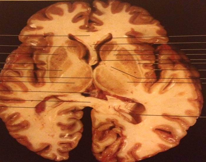 Horizontal brain section Quiz