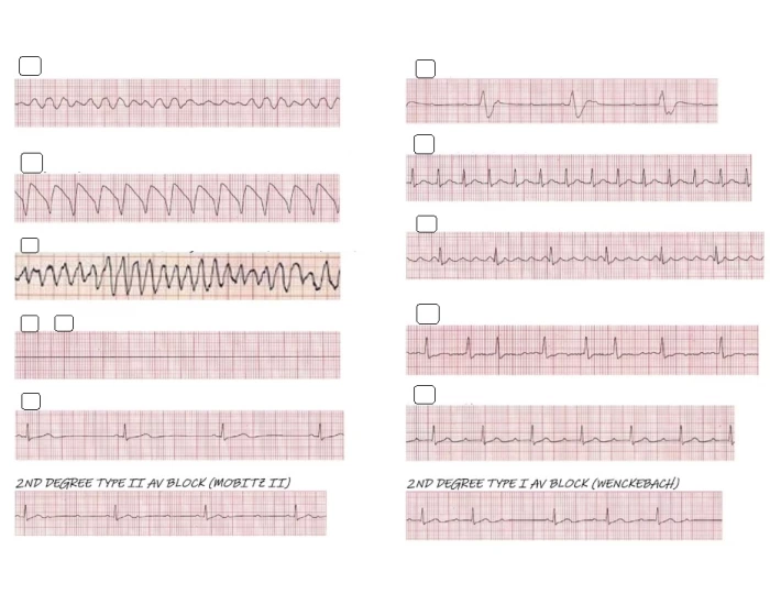 Random Rythm Rhythm Identify EKG Rhythms Game