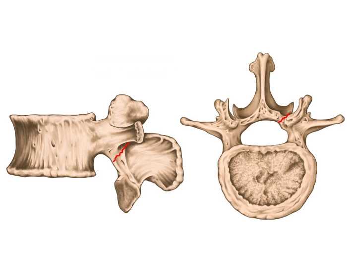 Arcus Vertebrae lumbar Vertebrae Quiz arcus-vertebrae-lumbar-vertebrae-quiz