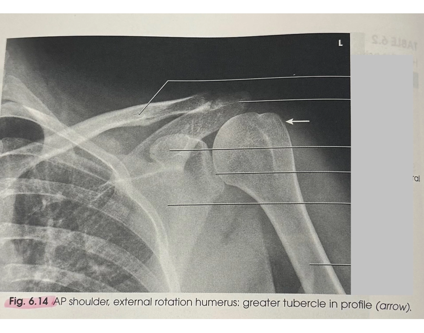 AP shoulder external rotation humerus — Printable Worksheet