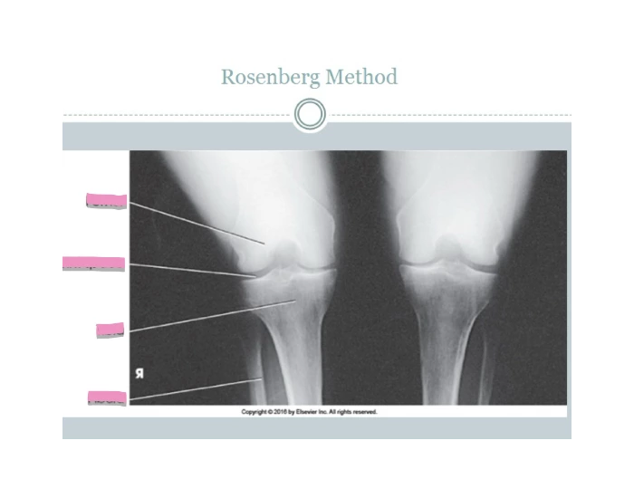 Normal Rosenberg. View Rosenberg method Quiz