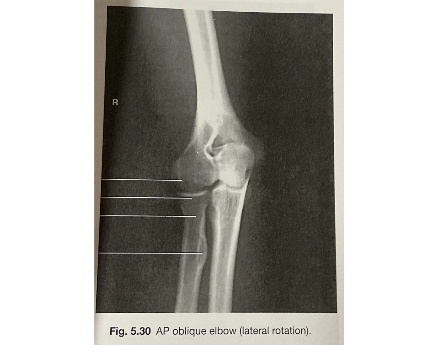 Elbow Extneral Rotation AP oblique elbow- lateral rotation Quiz