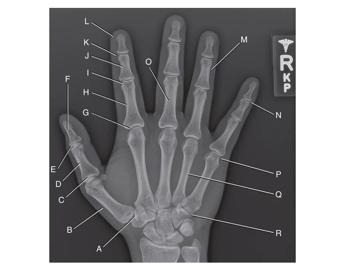 True Ap Hand PA radiograph- HAND Quiz