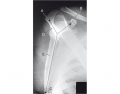 Fig 6 Lateral scapula radiograph