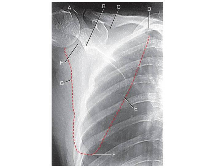 Scapula Radiograph Template Fig 6 AP scapula radiograph — Printable Worksheet