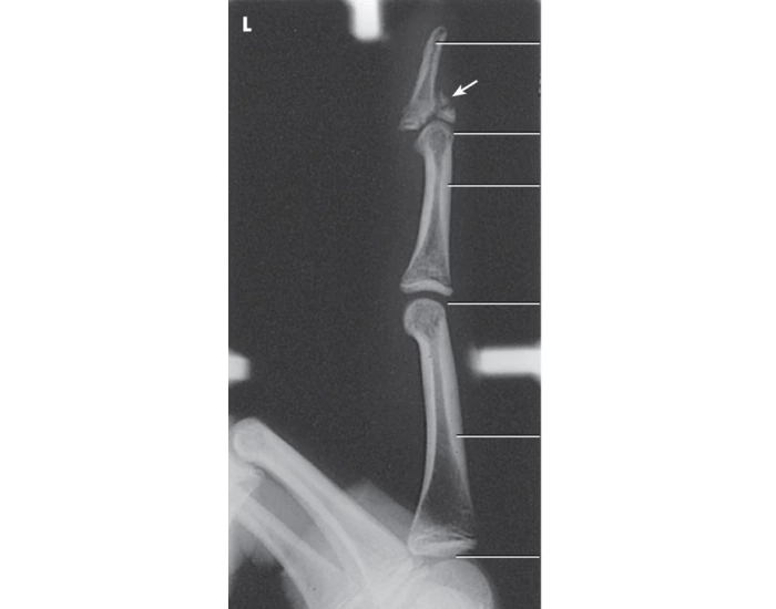 3rd Digit X Ray Routine Lateral Digit Xray Quiz