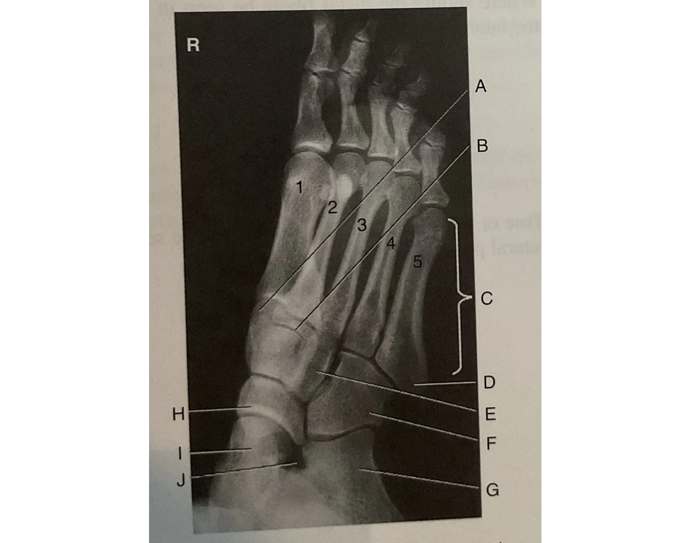 Mid Foot Internal Rotation AP oblique foot, medial (internal) rotation Quiz