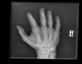 PA Hand Radiograph 