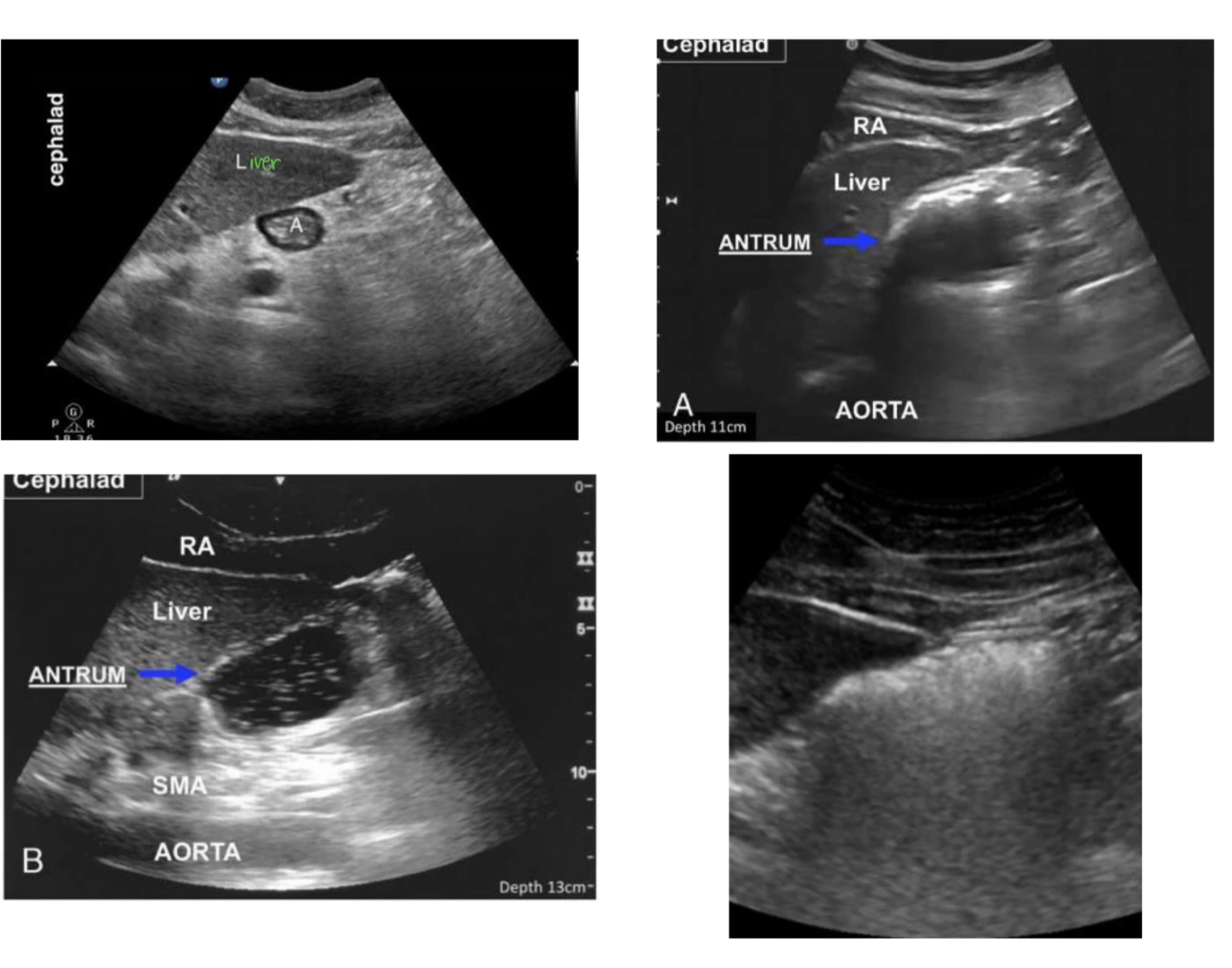 Basic Pocus Views POCUS: Interpretation of gastric views Quiz