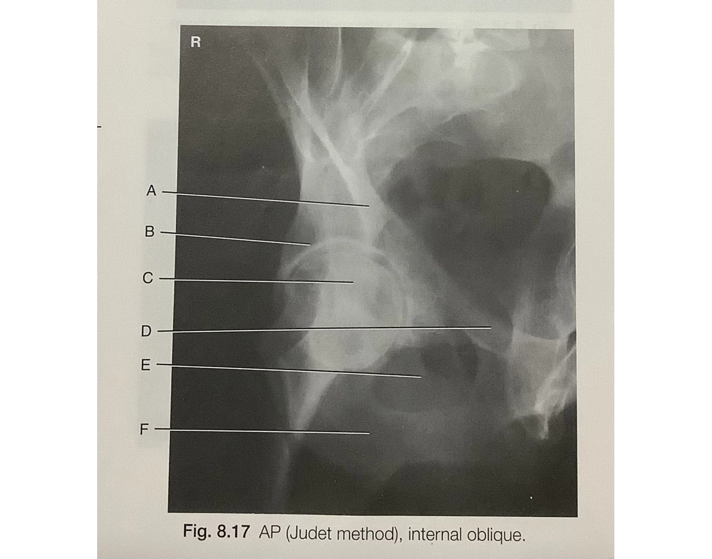 Judet Method Radiography AP Judet Method (Internal Oblique) Quiz