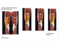 The Hamstrings Group of Muscles — Printable Worksheet