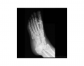 AP Oblique Foot Radiograph