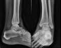 Lateral & Mortise Ankle Radiographs