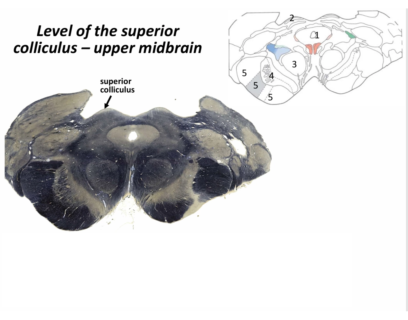Level of the Superior Colliculus- Upper Midbrain Quiz