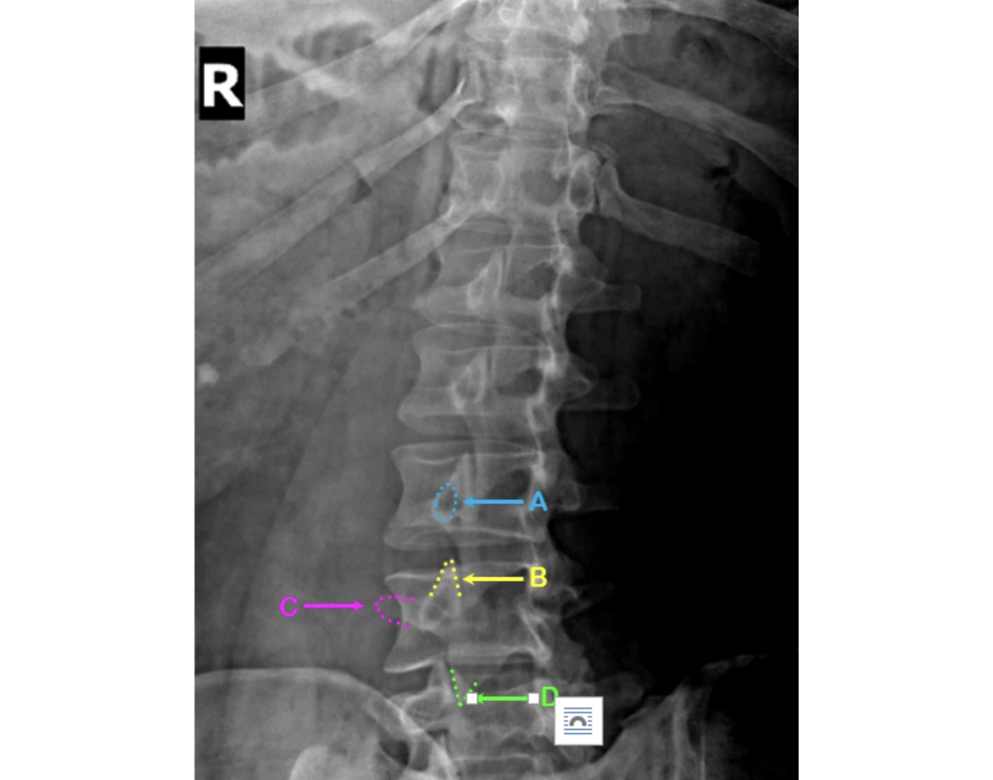 X ray of RPO Lumbar Spine Labeling Quiz