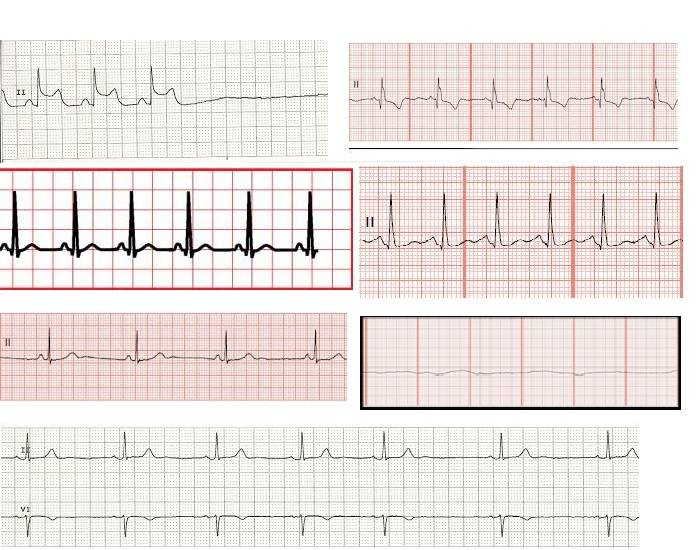 EKG RHYTHM IDENTIFICATION Quiz