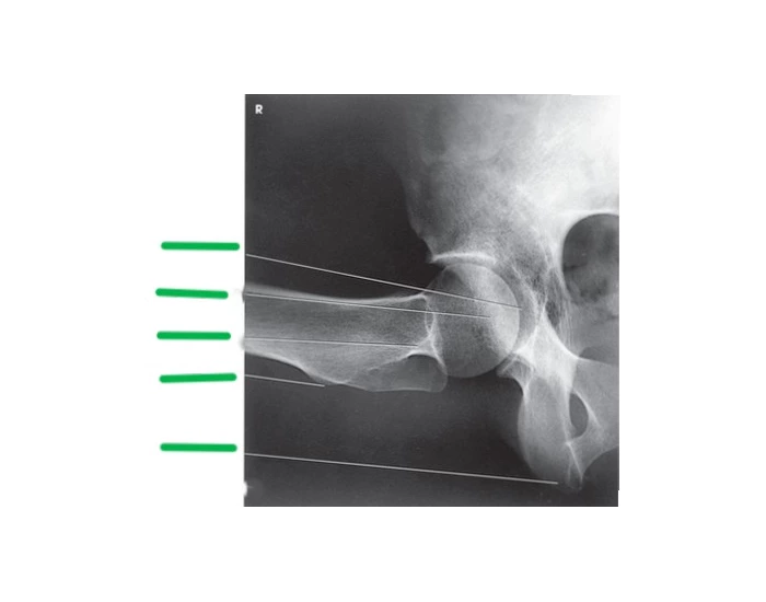 Lowenstein Rx Lateral Hip Xray (Lauenstein and Hickey Method) Quiz