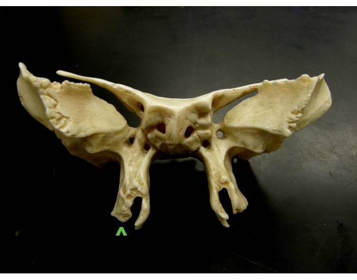 Quick Anterior Exploded Sphenoid Bone Quiz
