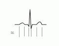 EKG Waveform