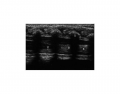 Spinal Cord Ultrasound
