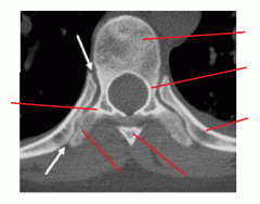 Thoracic Vertebra Axial CT Image