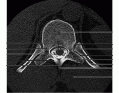Thoracic Vertebra Axial MRI image