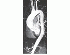 3D Imaing of the aorta arch and desending