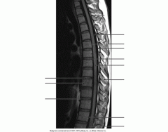 Thoracic Vertebra Sagital MRI image