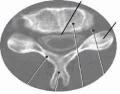 Cervical Vertebra Axial Slice CT